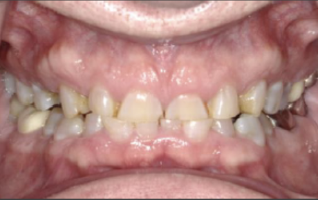 erosive tooth lesions erosive tooth lesions