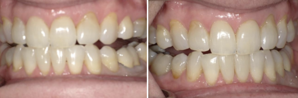 posterior open bites