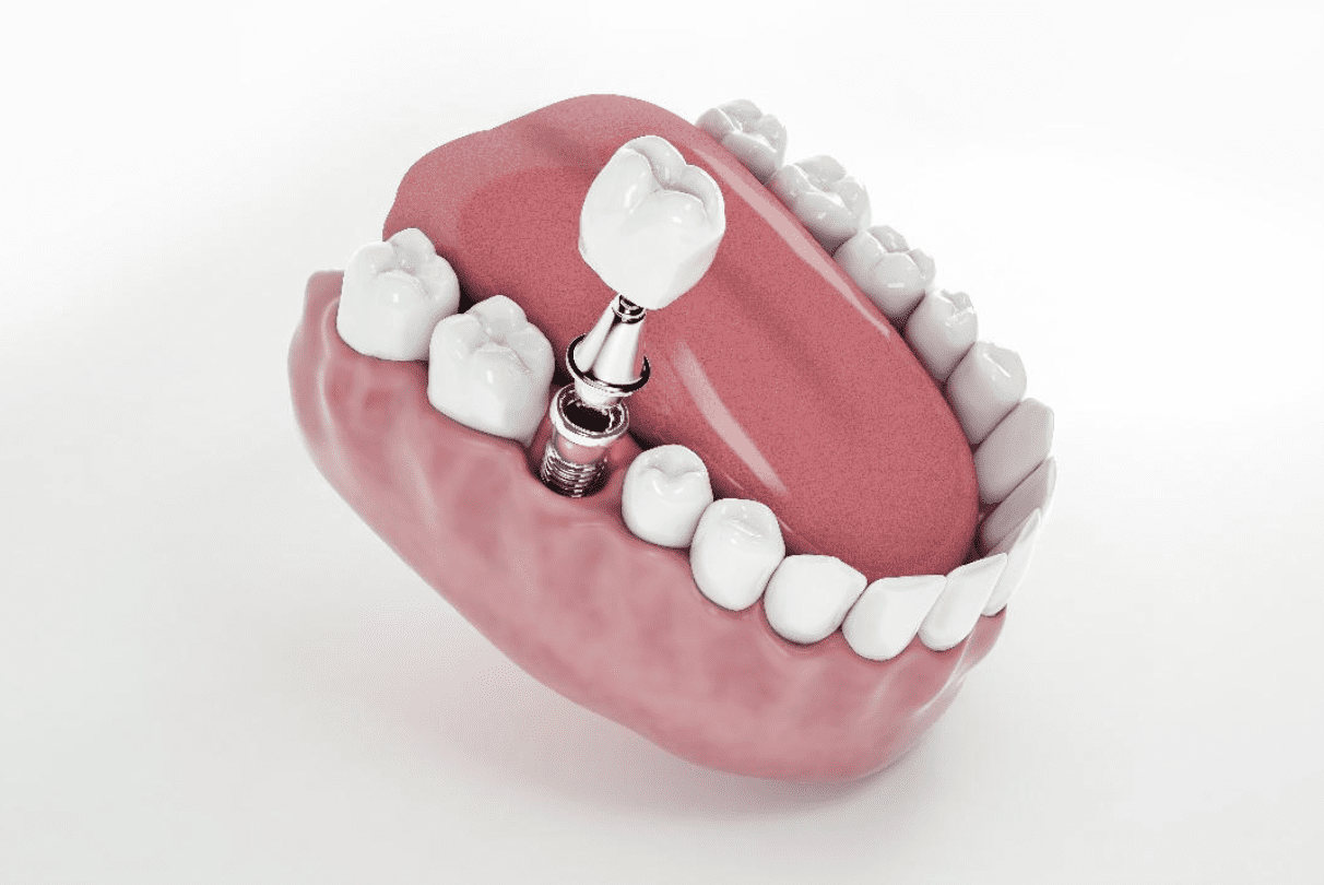 Simple Tip For Cementation of Crowns on Implant Abutments Simple Tip For Cementation of Crowns on Implant Abutments