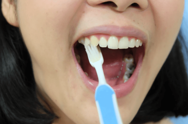 fluoride varnish fluoride varnish